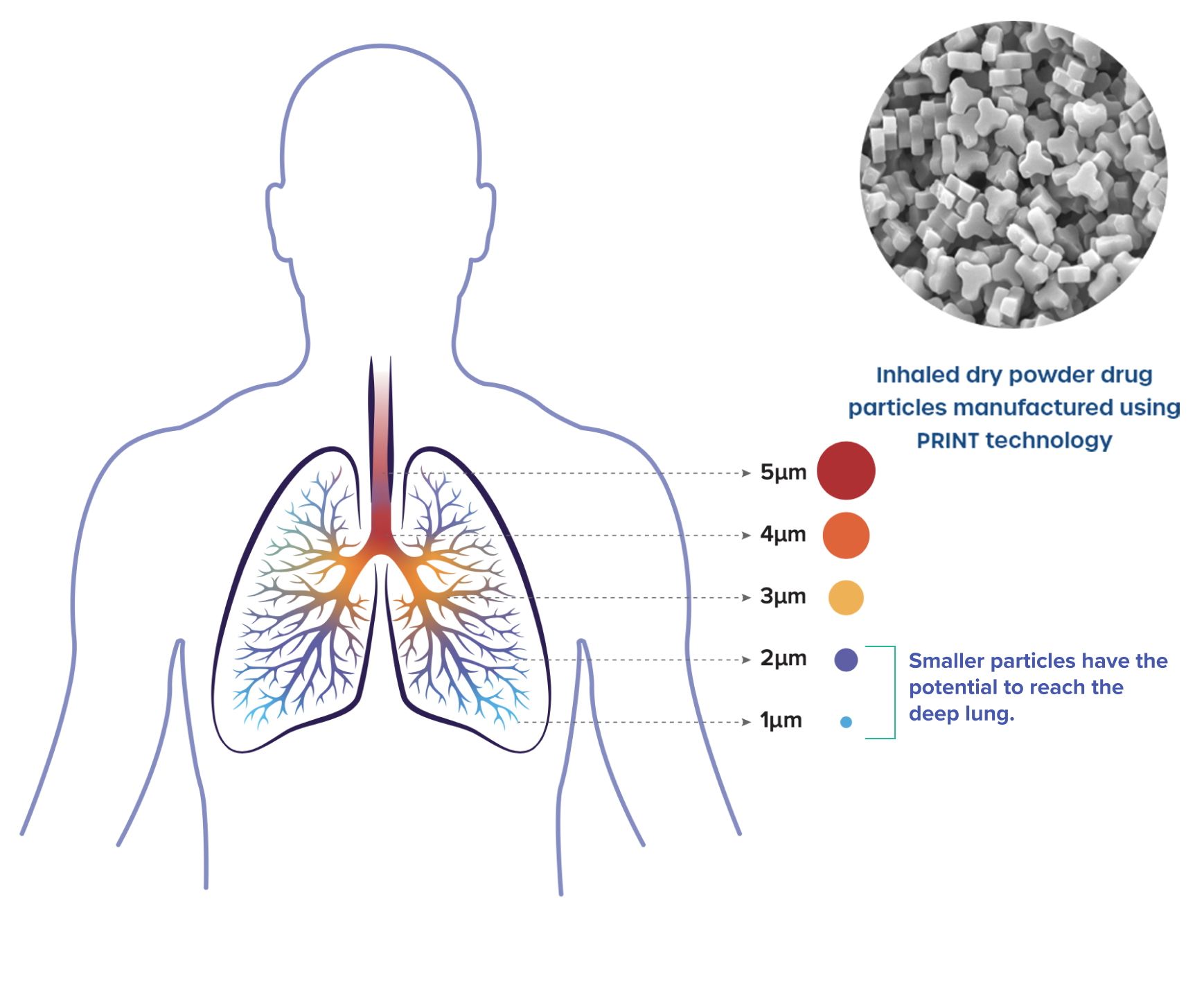 Diagram of human lungs with bronchi. Colored dots represent inhaled dry powder particles ranging from 1 to 5 micrometers in size. Smaller particles (blue, 1-2µm) reach deeper into the lungs than larger particles (red, 5µm) which deposit higher in the airways. Inset image shows magnified view of dry powder particles.